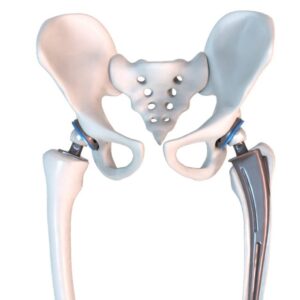hip_replacement